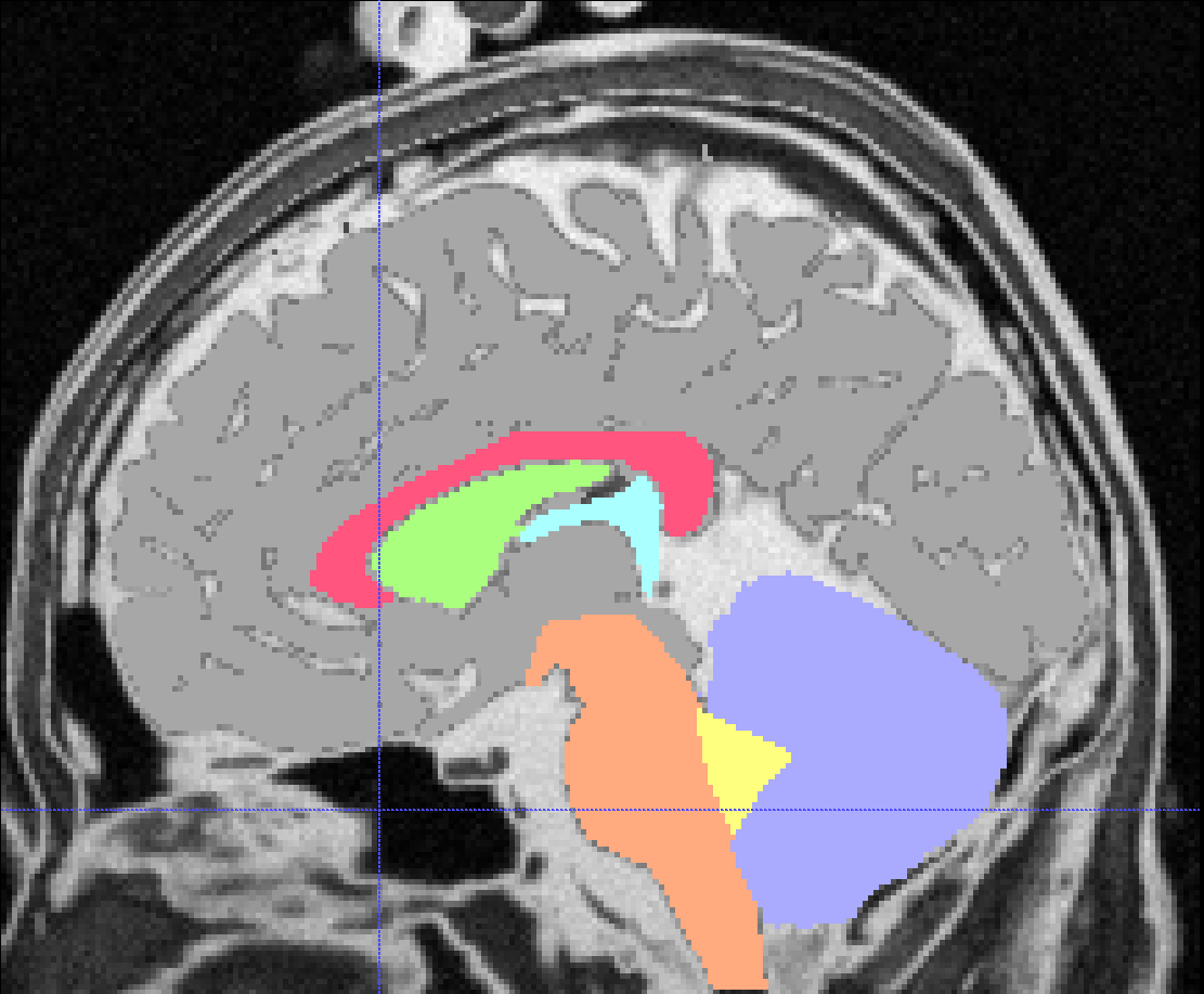 Brain Segmentation